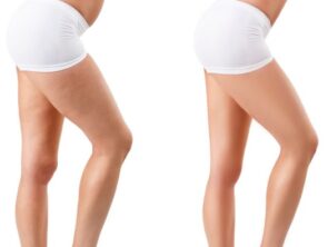 CELLULITE CELLULITE
