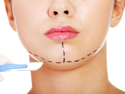CHIN AUGMENTATION