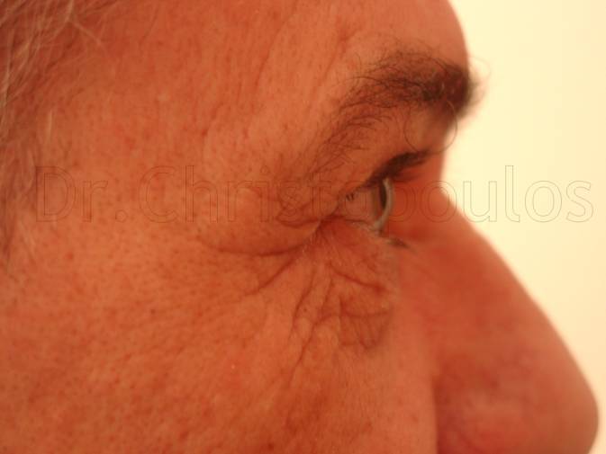 Before-Blepharoplasty