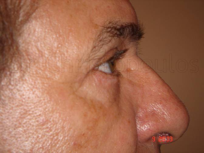 After-Blepharoplasty