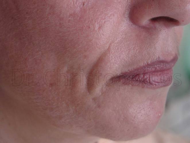 Before-Fat Implantation