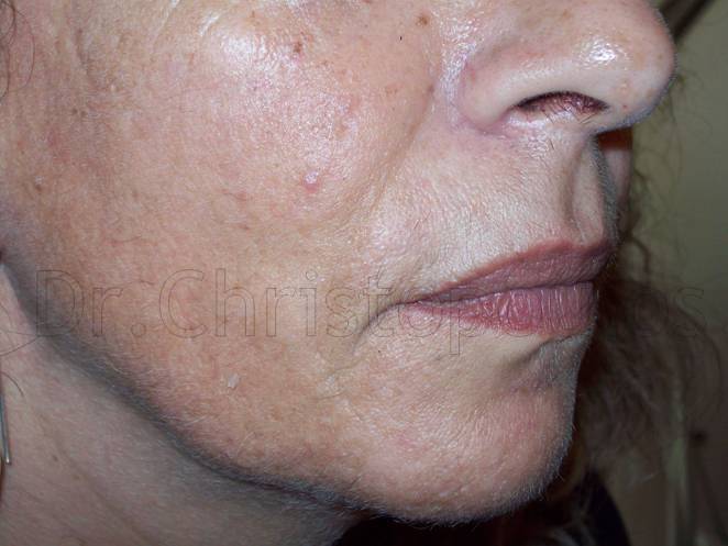 After-Fat Implantation