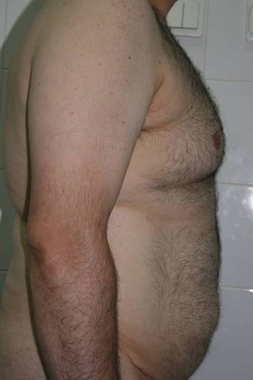 Before-Gynecomastia