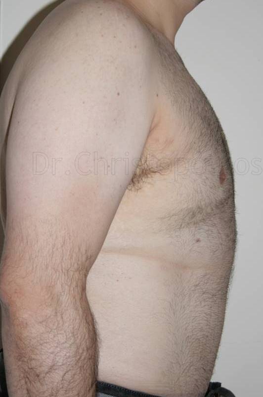 After-Gynecomastia