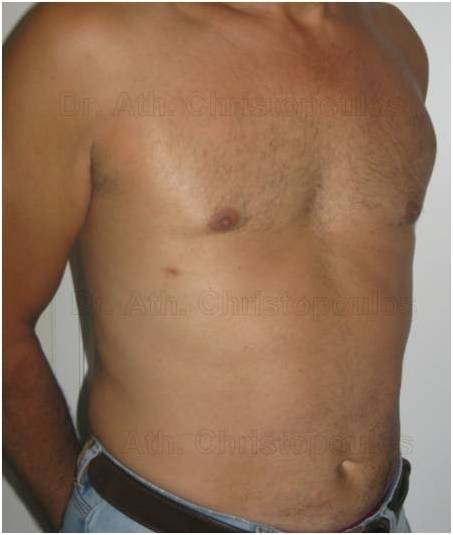 After-Gynecomastia