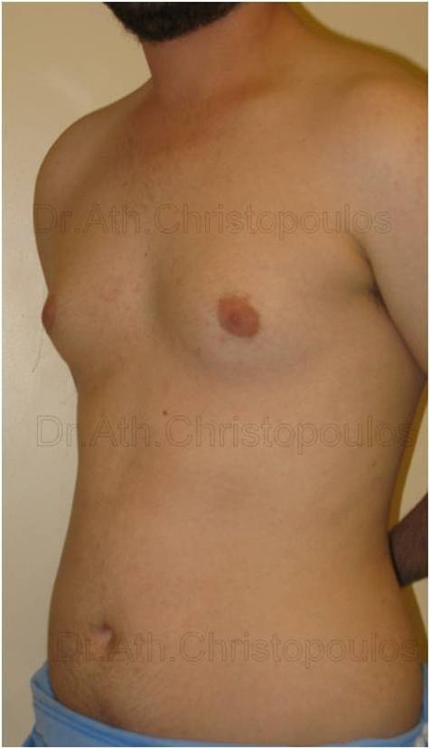 Before-Gynecomastia