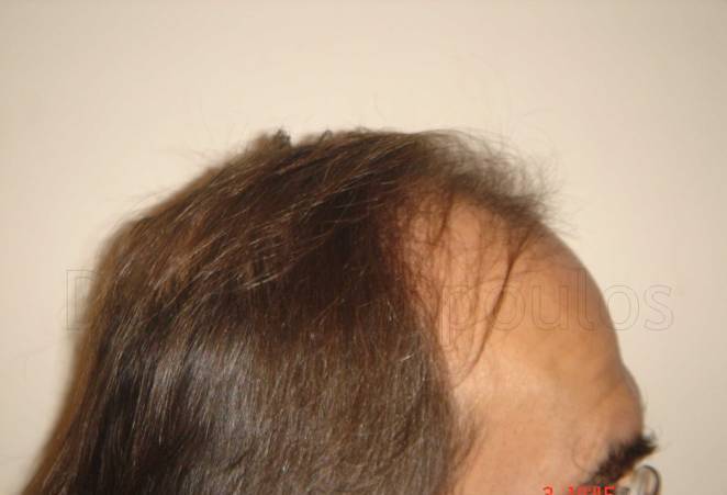 Before-Hair Transplantation