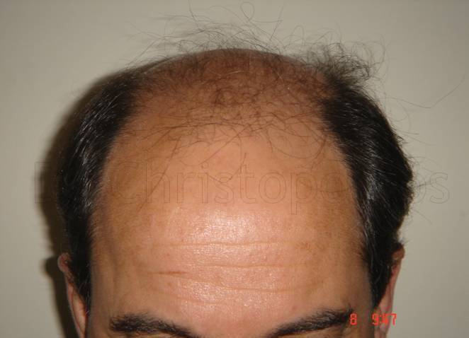 Before-Hair Transplantation