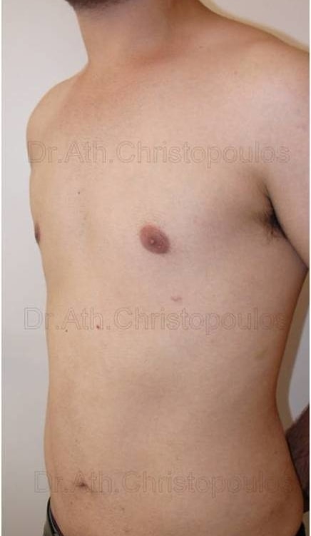 After-Gynecomastia
