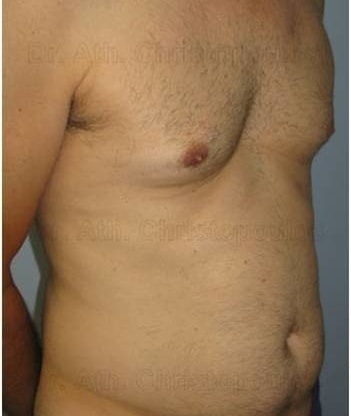 Before-Gynecomastia