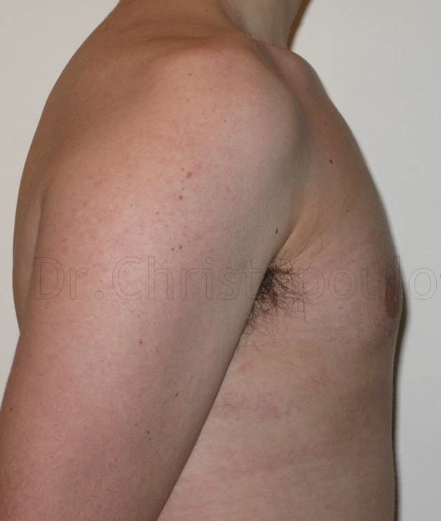 After-Gynecomastia