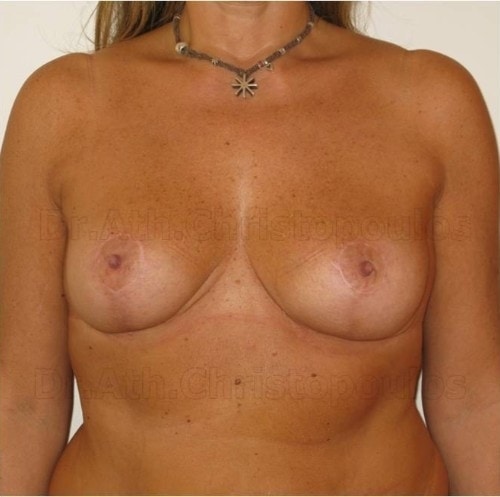 After-Breast Lift