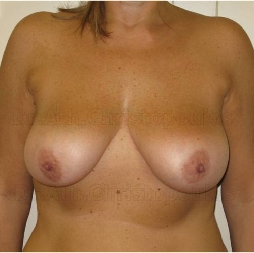 Before-Breast Lift