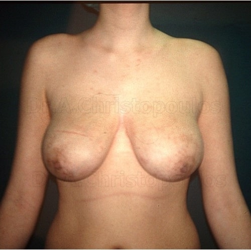 Before-Breast Lift