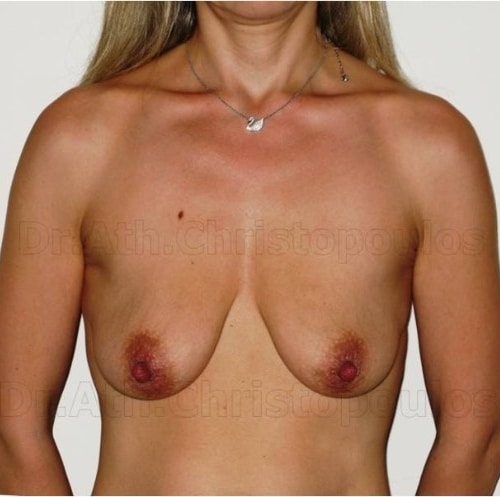 Before-Breast Lift