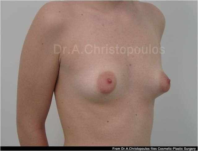 Before-Breast Augmentation