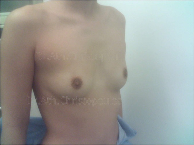 Before-Breast Augmentation