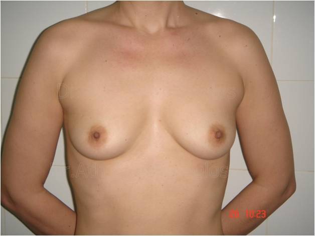 Before-Breast Augmentation