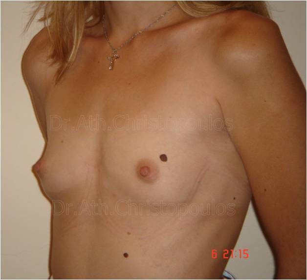 Before-Breast Augmentation