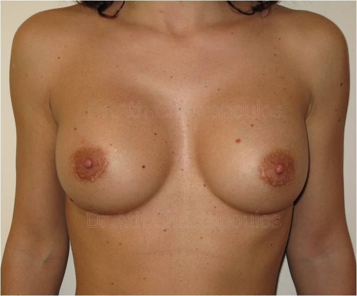 After-Breast Augmentation