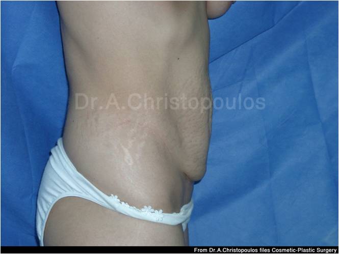 Before-Abdominoplasty