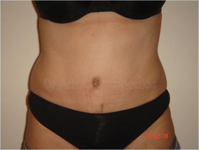 After-Abdominoplasty