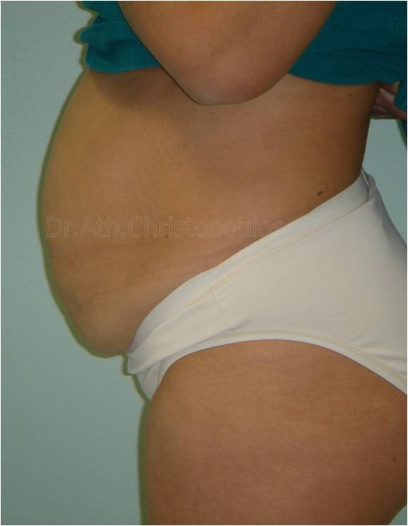 Before-Abdominoplasty