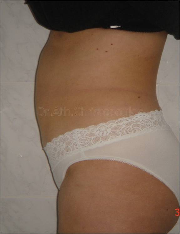 After-Abdominoplasty