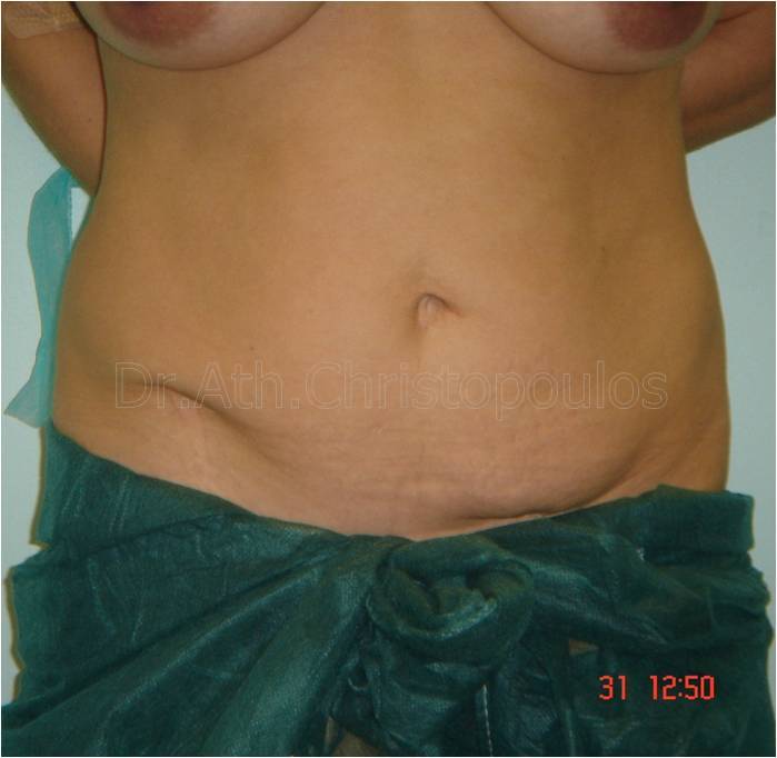 Before-Abdominoplasty