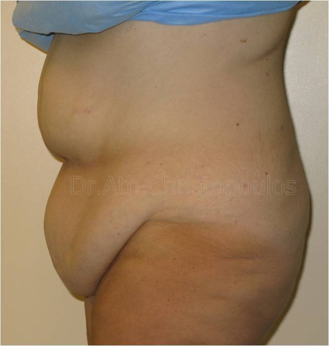 Before-Abdominoplasty