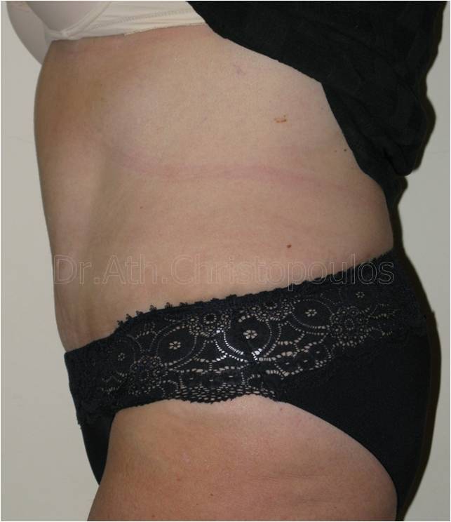 After-Abdominoplasty
