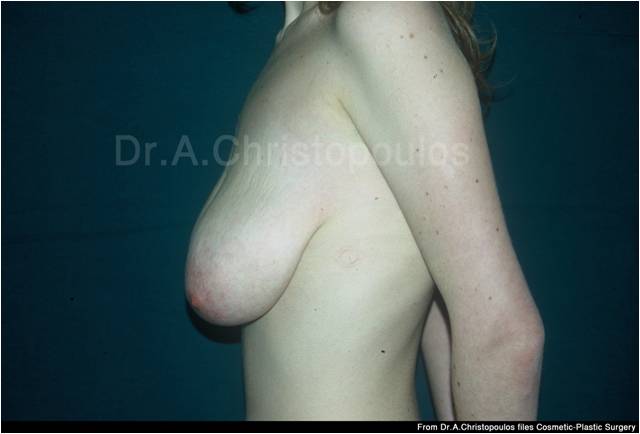 Before-Breast Reduction