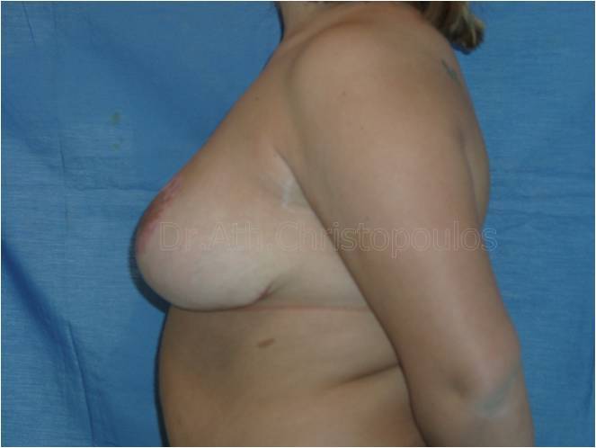 After-Breast Reduction