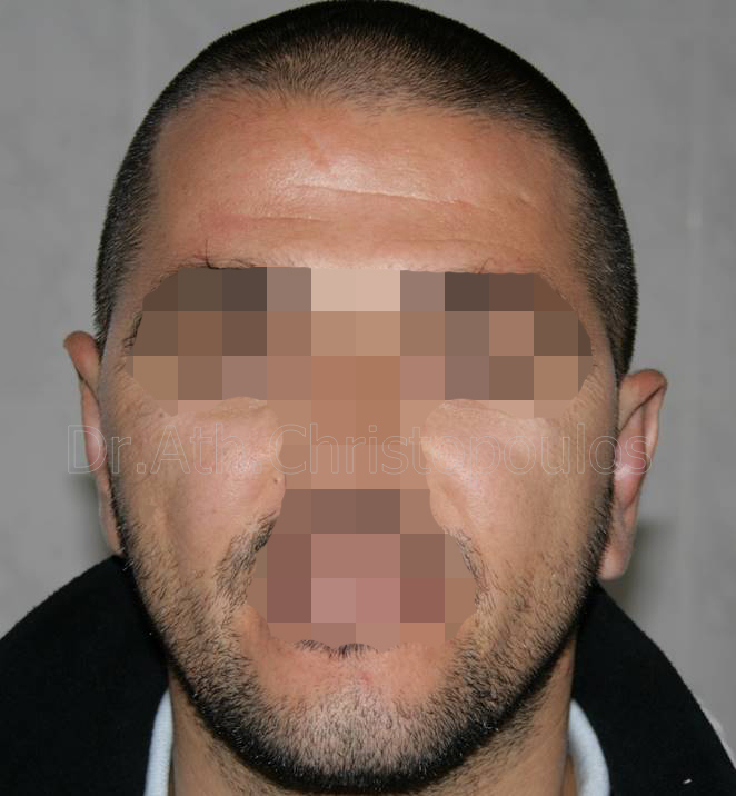 After-Otoplasty
