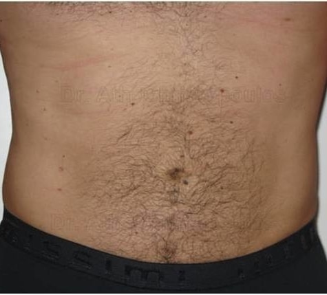 After-Liposuction