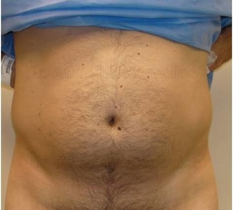 Before-Liposuction