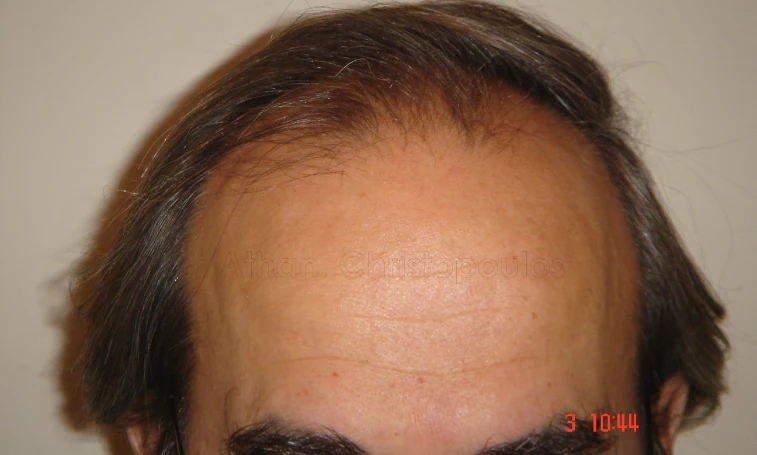 Before-Hair Transplantation
