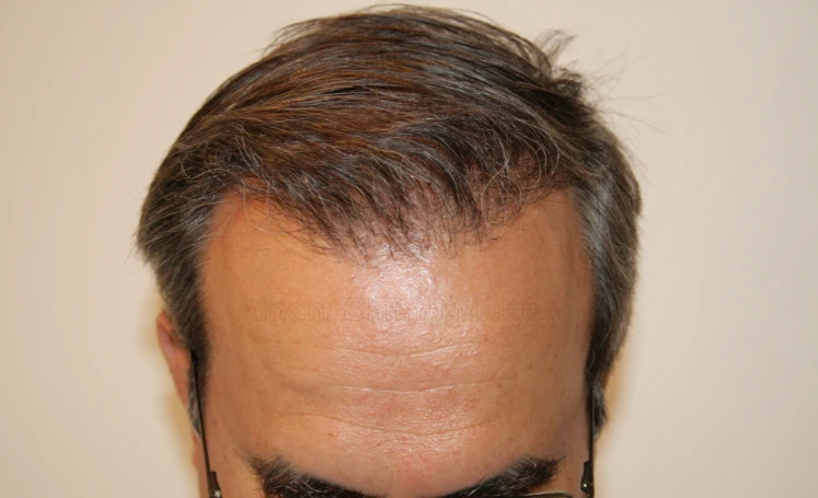 After-Hair Transplantation