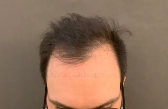 Before-Hair Transplantation
