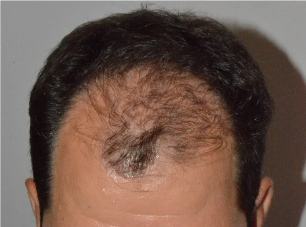 Before-Hair Transplantation