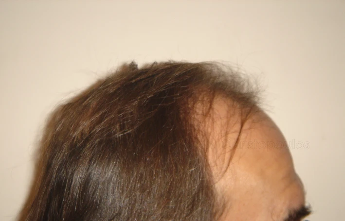 Before-Hair Transplantation