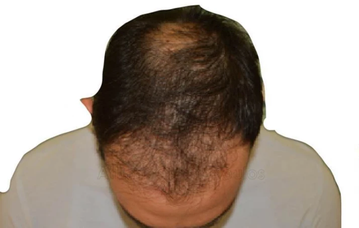 Before-Hair Transplantation