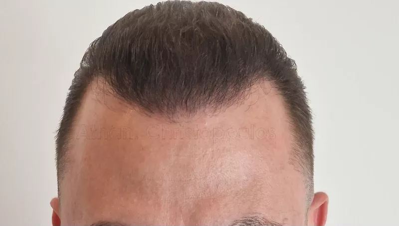 After-Hair Transplantation