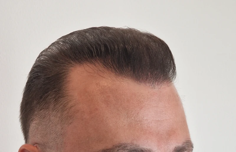 After-Hair Transplantation