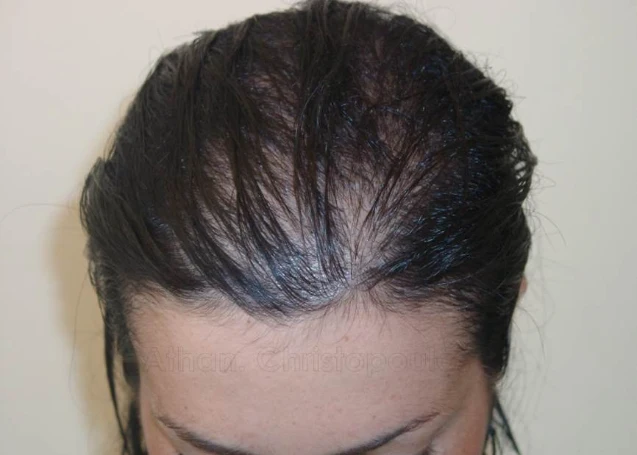 Before-Hair Transplantation
