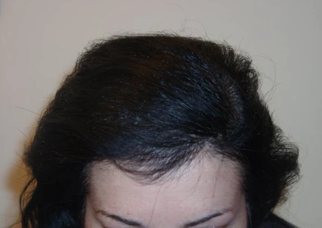 After-Hair Transplantation