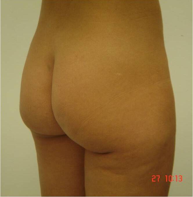 Before-Buttock augmentation