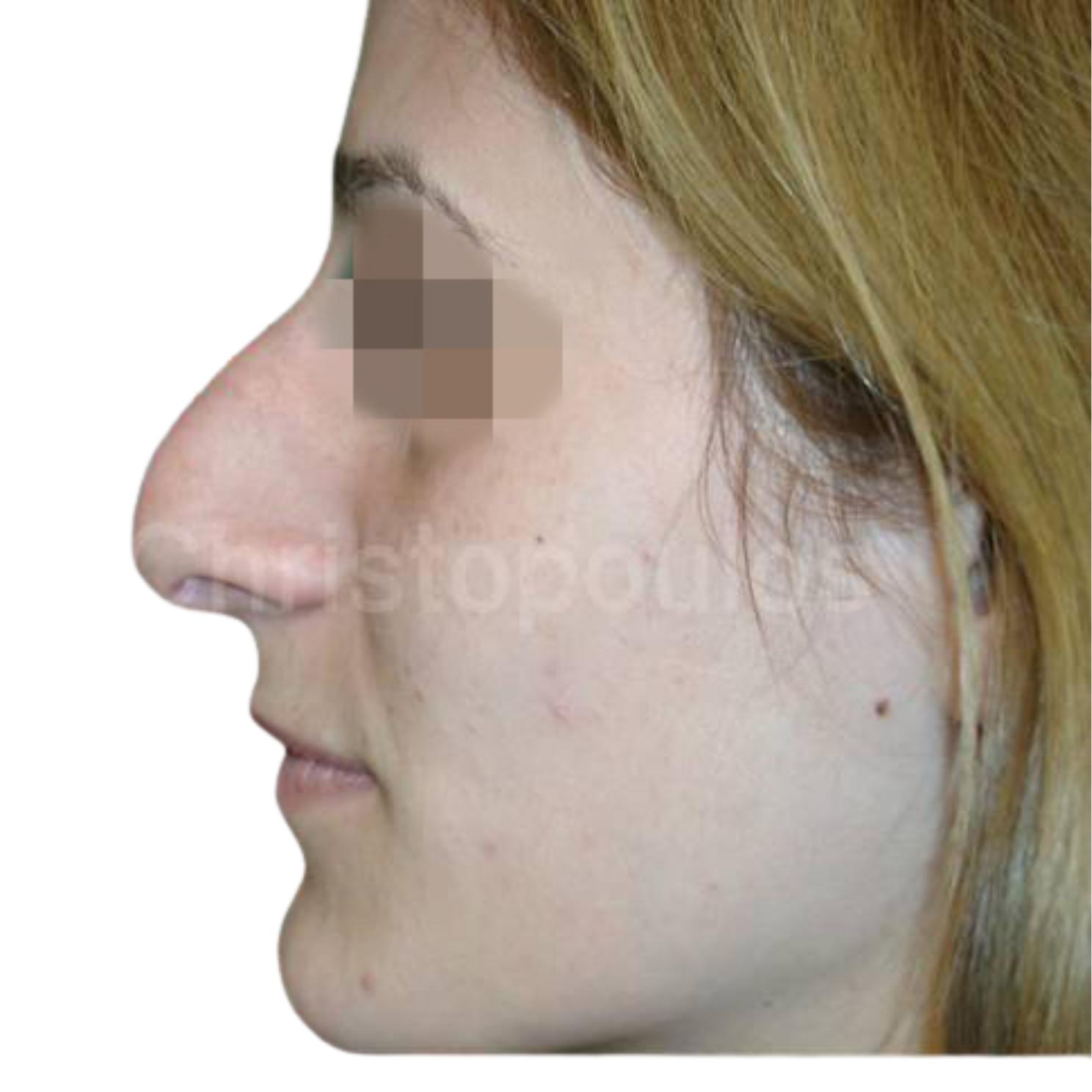 Before-Rhinoplasty
