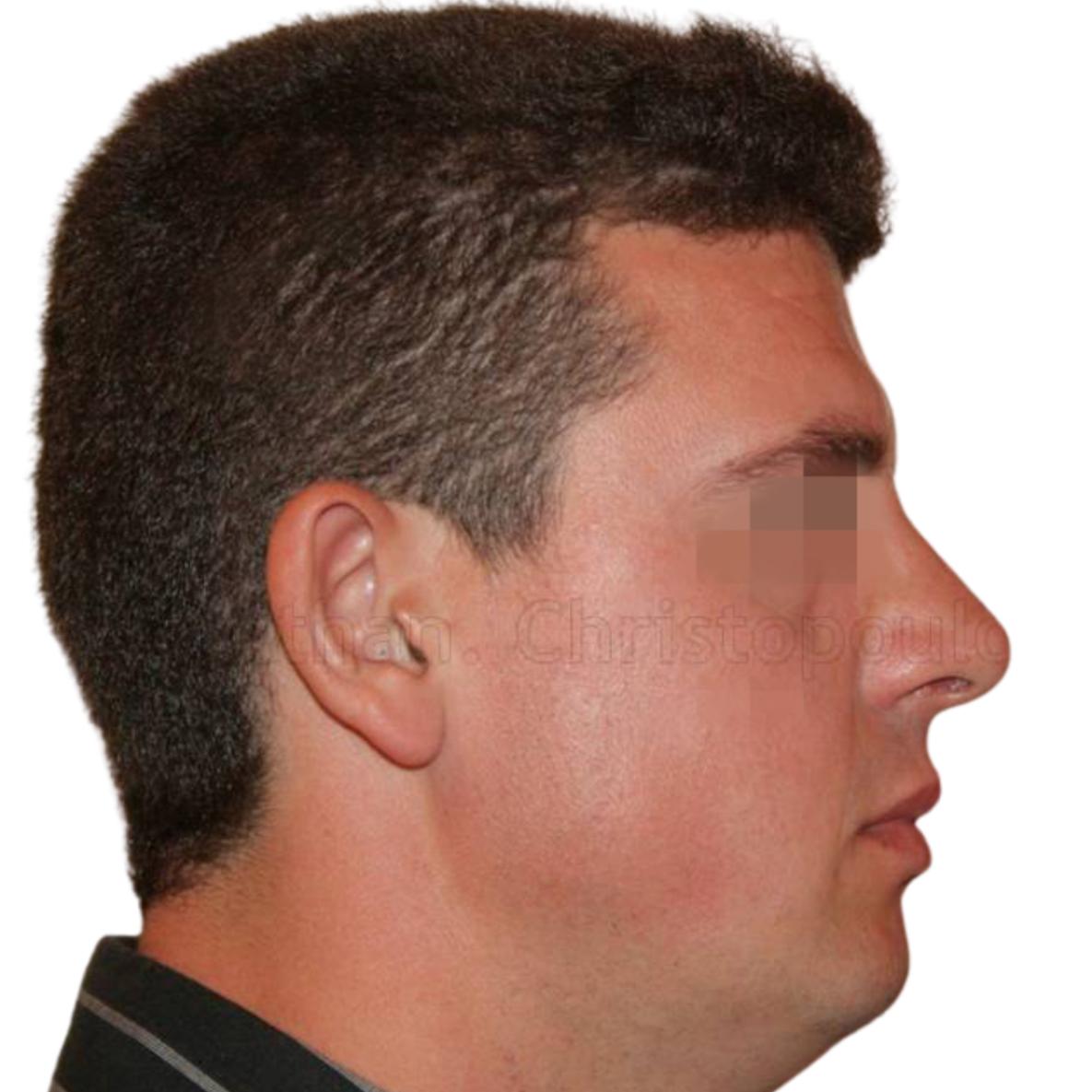 After- Rhinoplasty