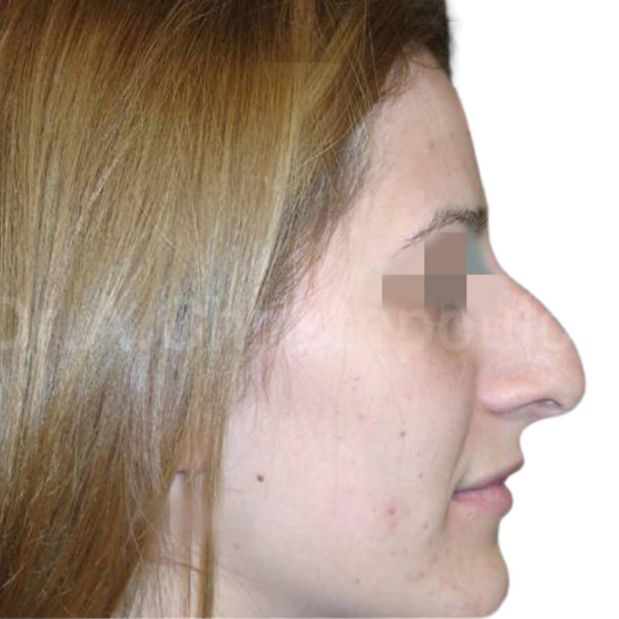 Before-Rhinoplasty